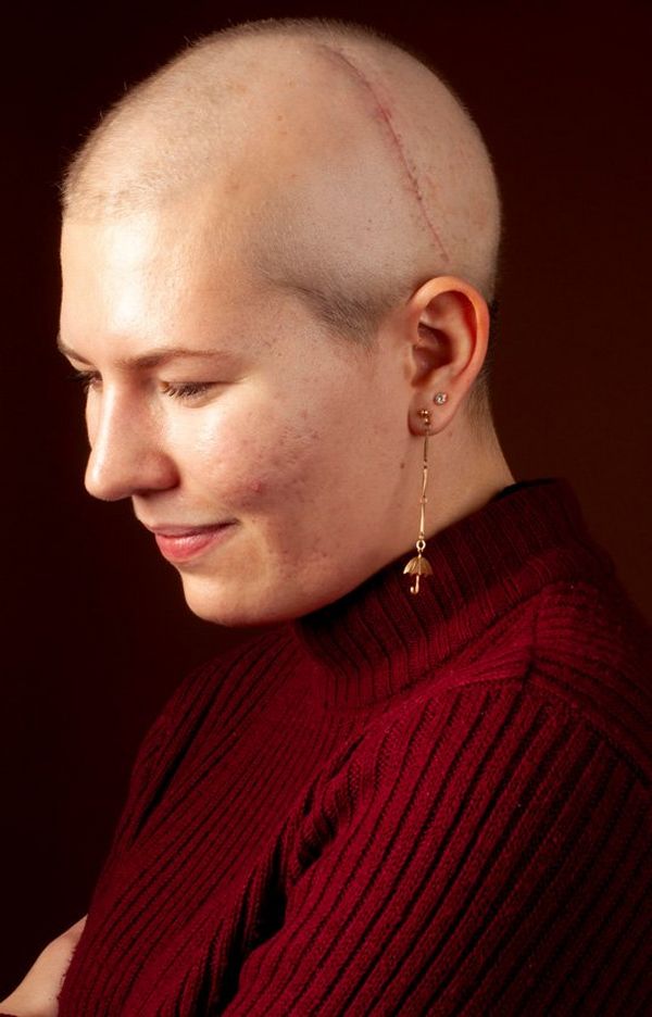 A woman in a red roll-neck sweater and earrings. She has no hair and a thin scar stretching from behind her ear and over her head.